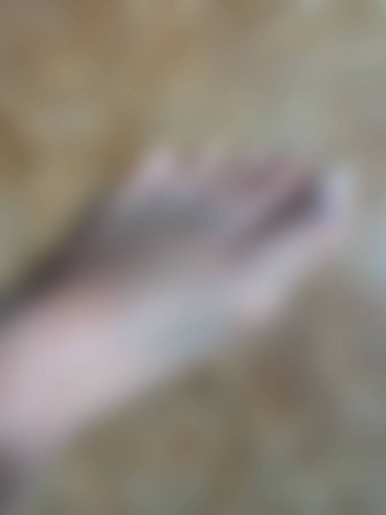 More of the bruising from a few days after the fracture. It’s still bruised right now. 3 w