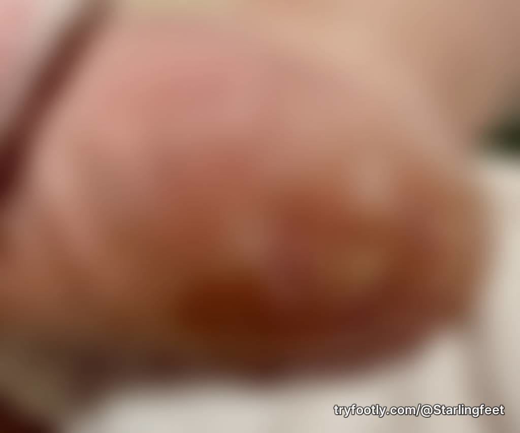 This is a sample of what the bottom of my feet look like. I will share the journey includi