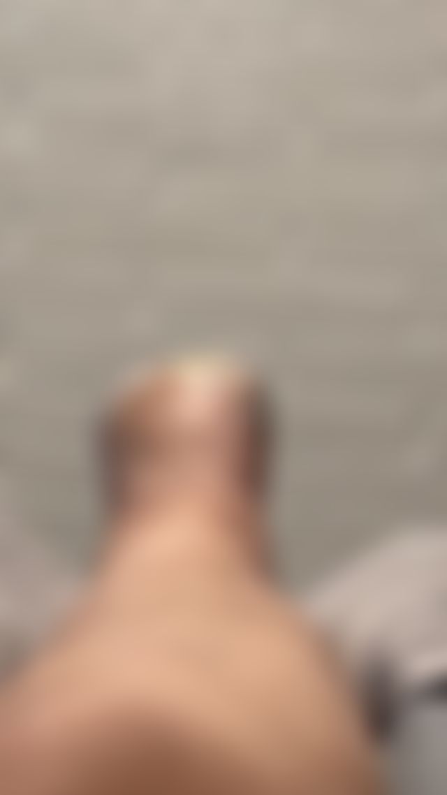 Wiggle wiggle 😜 post toe amputation. Healing well