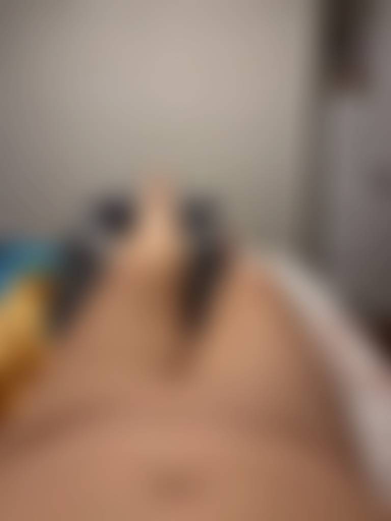 Healing after surgery. This was a month after having my toes amputated✌🏼🩷