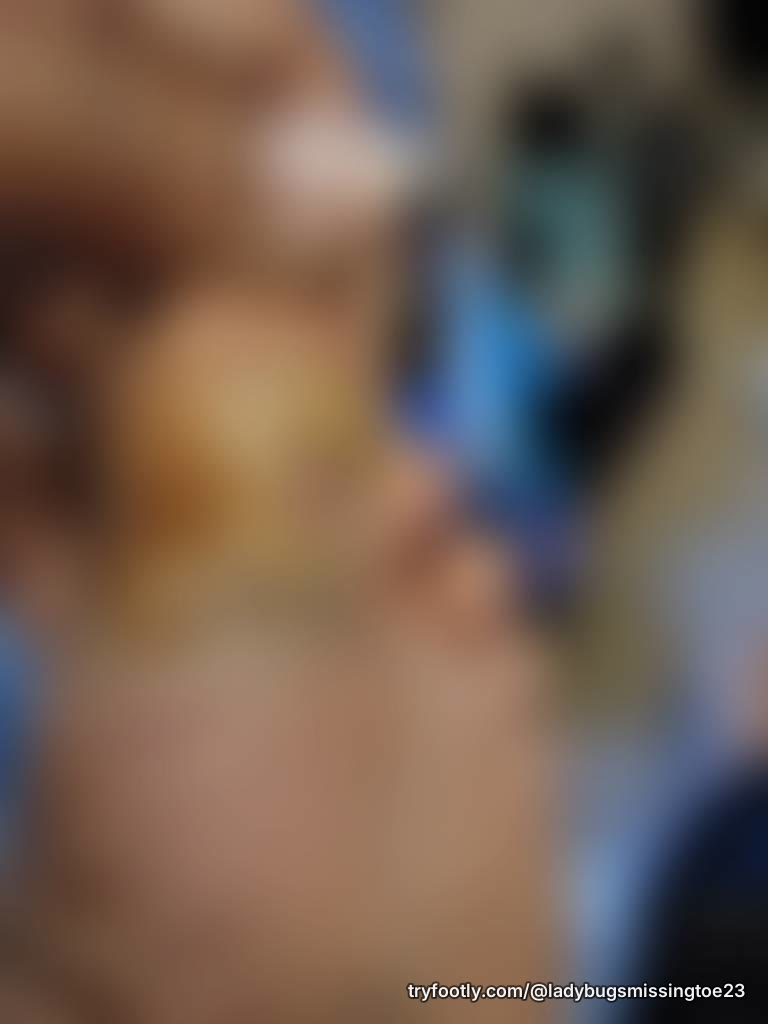 My foot was in a cast for 3 months